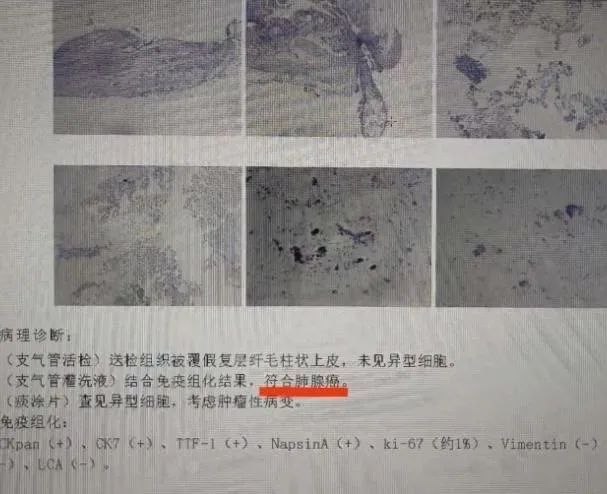 【名医名科】反复肺炎究竟为何？支气管镜检查为肺癌(图2)